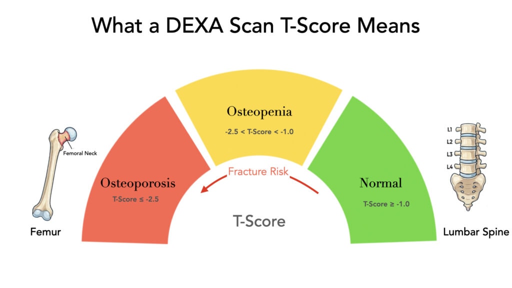 How to Read the DEXA scan Results for Bone Density. 
Osteoporosis: T-Score ≤ -2.5
Osteopenia: -2.5 < T-Score < -1.0
Normal: T-Score ≥ -1.0